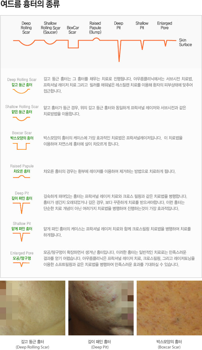 여드름흉터의 종류