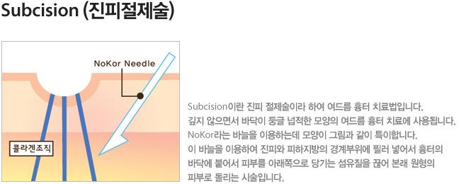 Subcision 진피절제술