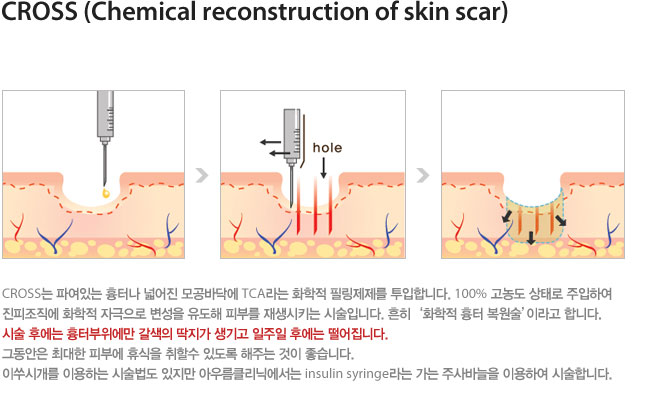Cross (Chemical reconstruction of skin scar)