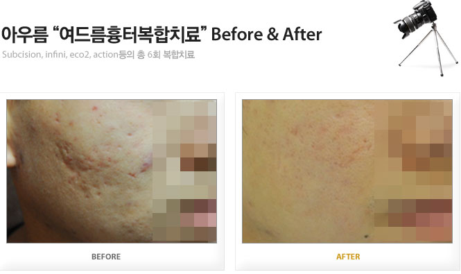 아우름 여드름흉터복합치료 Before&After