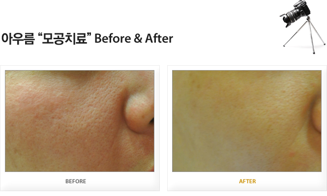 아우름 모공치료 Before&After