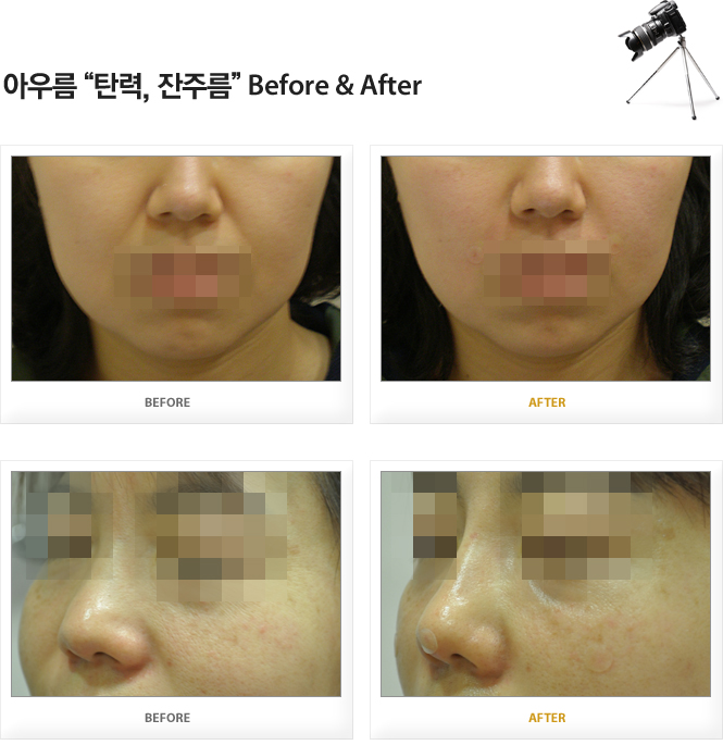아우름 탄력,잔주름 Before&After