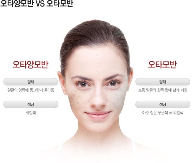오타양모반 VS 오타모반