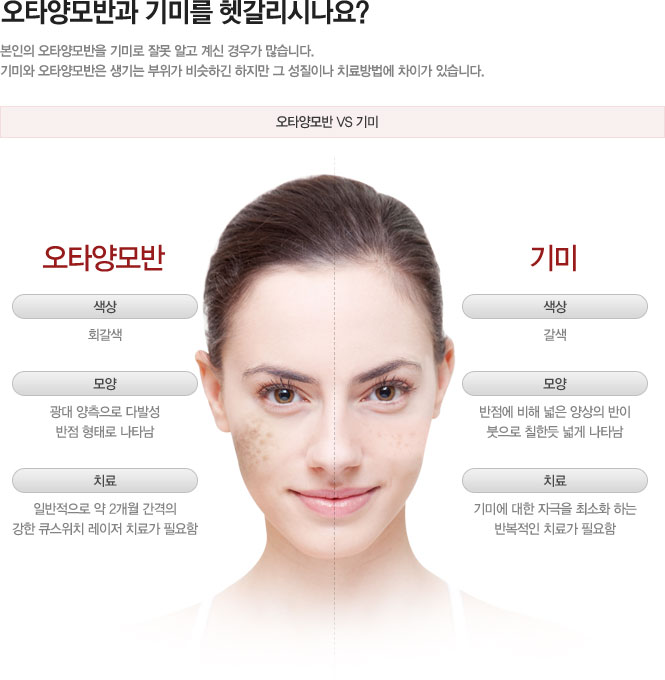 오타양모반점과 기미를 헷갈리시나요?
