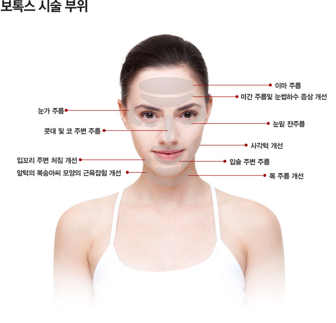 보톡스 시술 부위