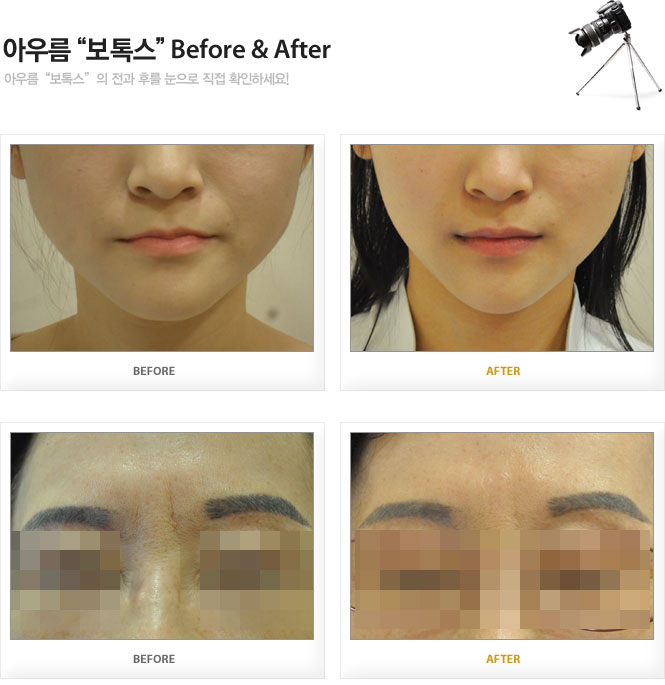 아우름 보톡스 Before&After