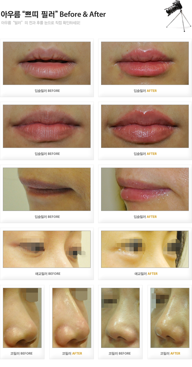 아우름 필러 Before&After