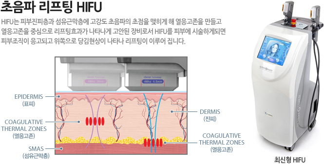 HIFU 리프팅
