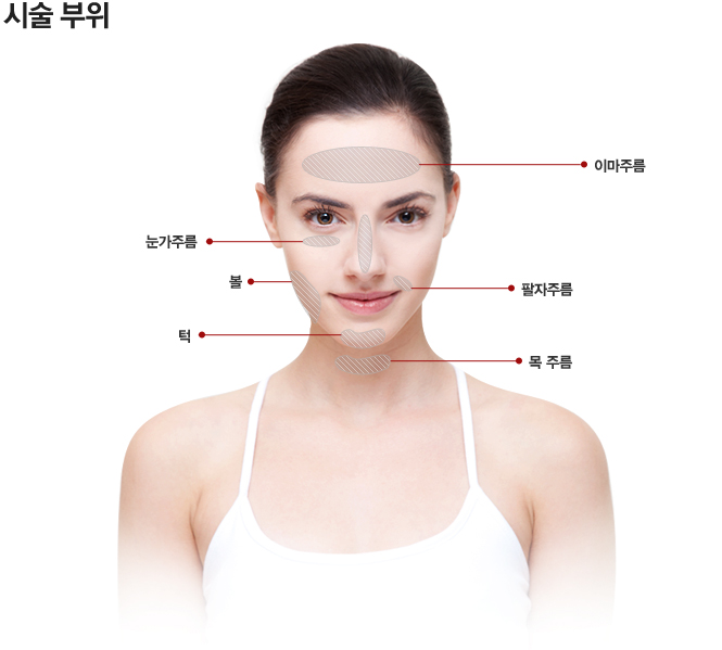 HIFU 리프팅