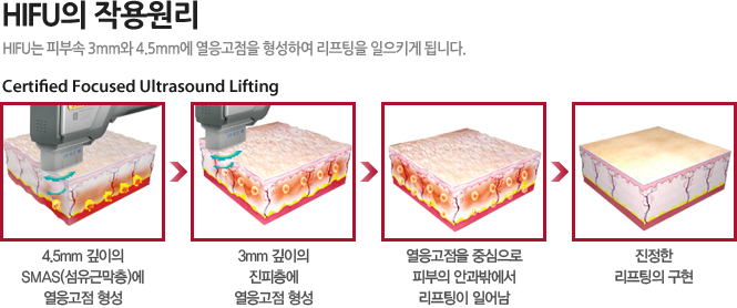 HIFU 리프팅